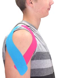Deltoid Taping