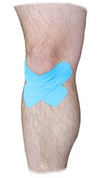 Osgood-Schlatter Taping